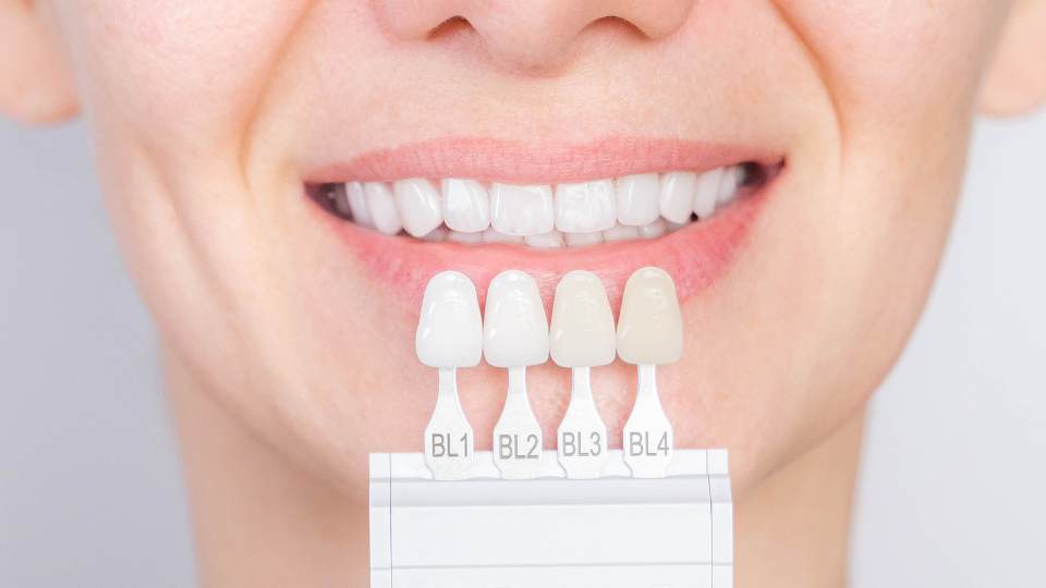 Veneers – Welche Arten gibt es und was sind ihre Unterschiede?