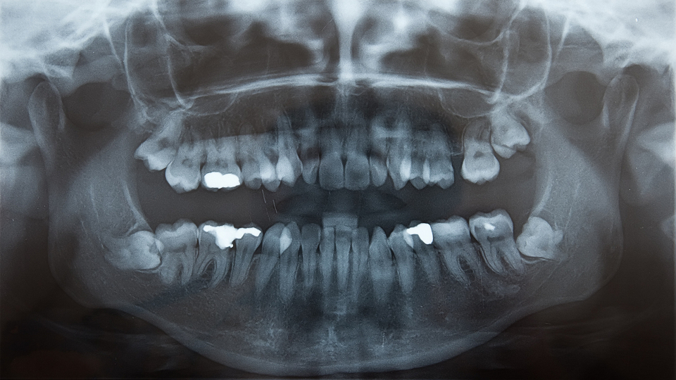 Das „Problemkind“ des Kiefers lässt sich auf Röntgenaufnahmen meist deutlich erkennen. 
