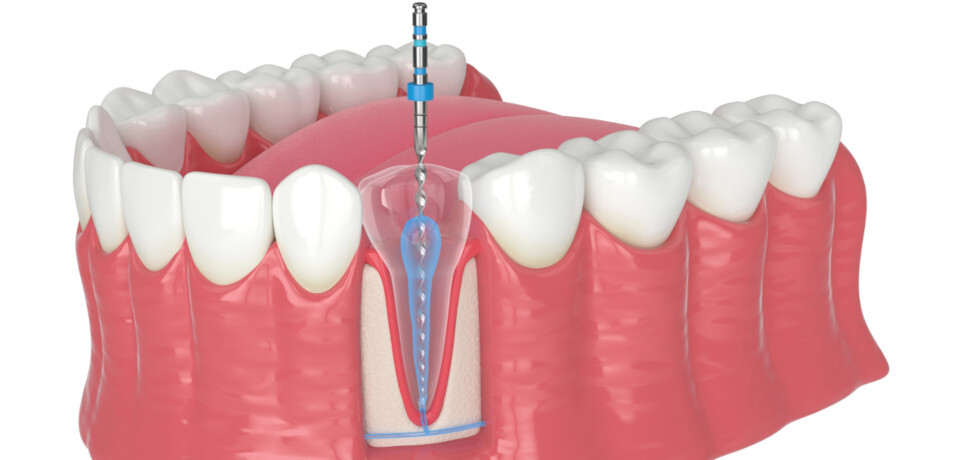Modell eines Gebisses und einer Endodontie