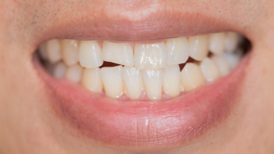 Nach einer Zahnverletzung kommt es auf die richtige Erstversorgung an